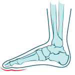 forefoot-pain-zw-lower-and-lower-limb-3-1320x1319