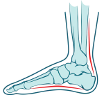 tendon-foot-pain-zw-lower-and-lower-limb-3-1320x1320